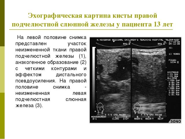 Эхографическая картина кисты правой подчелюстной слюнной железы у пациента 13 лет На левой половине снимка представлен участок неизмененной ткани правой подчелюстной железы (1), анэхогенное образование (2) с четкими контурами и эффектом дистального …