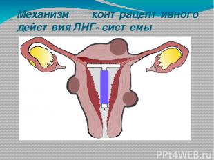Механизм контрацептивного действия ЛНГ- системы