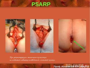PSARP При реконструкции мышечного комплекса не создается избытка низведенной сли