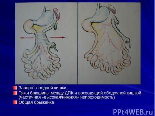 Заворот средней кишки Тяжи брюшины между ДПК и восходящей ободочной кишкой (част