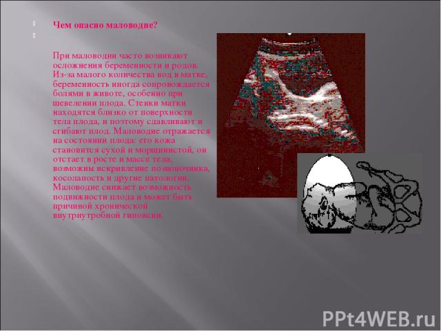 Чем опасно маловодие? При маловодии часто возникают осложнения беременности и родов. Из-за малого количества вод в матке, беременность иногда сопровождается болями в животе, особенно при шевелении плода. Стенки матки находятся близко от поверхности …