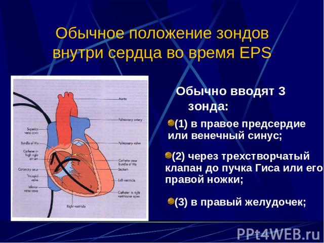 Обычное положение зондов внутри сердца во время EPS Обычно вводят 3 зонда: (1) в правое предсердие или венечный синус; (2) через трехстворчатый клапан до пучка Гиса или его правой ножки; (3) в правый желудочек;