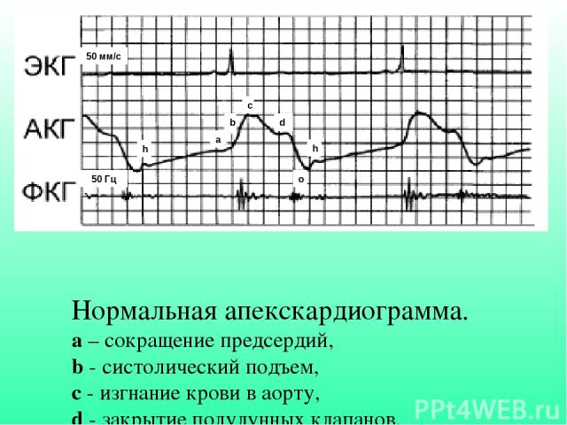 Нормальная апекскардиограмма. а – сокращение предсердий, b - cистолический подъем, с - изгнание крови в аорту, d - закрытие полулунных клапанов, о - открытие митрального клапана, h - быстрое наполнение желудочков a b c d h o 50 Гц 50 мм/с h