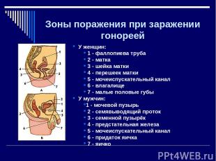 Зоны поражения при заражении гонореей У женщин: 1 - фаллопиева труба 2 - матка 3