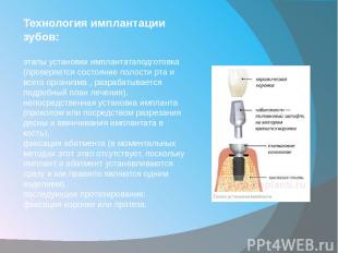 Технология имплантации зубов: этапы установки имплантатаподготовка (проверяется