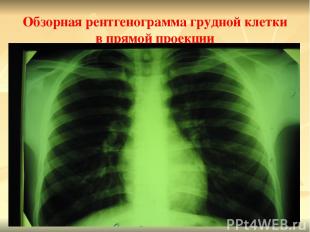 Обзорная рентгенограмма грудной клетки в прямой проекции