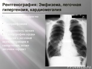 Рентгенография: Эмфизема, легочная гипертензия, кардиомегалия Уплощенная диафраг