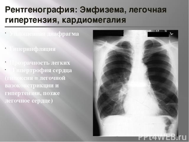 Рентгенография: Эмфизема, легочная гипертензия, кардиомегалия Уплощенная диафрагма Гиперинфляция Прозрачность легких Гипертрофия сердца (гипоксия = легочной вазоконстрикции и гипертензии, позже легочное сердце)