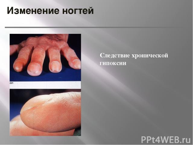 Изменение ногтей Следствие хронической гипоксии