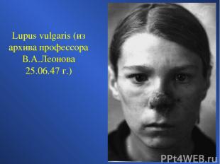 Lupus vulgaris (из архива профессора В.А.Леонова 25.06.47 г.)