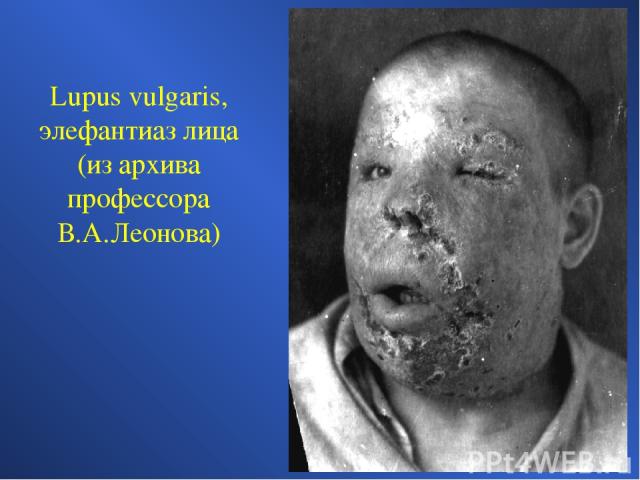 Lupus vulgaris, элефантиаз лица (из архива профессора В.А.Леонова)