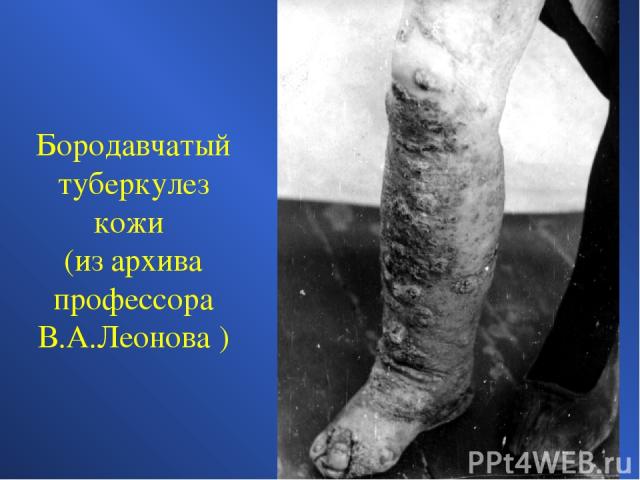 Бородавчатый туберкулез кожи (из архива профессора В.А.Леонова )