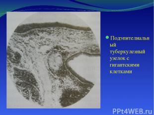 Подэпителиальный туберкулезный узелок с гигантскими клетками