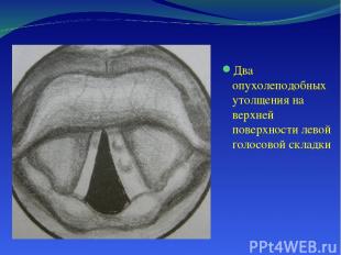Два опухолеподобных утолщения на верхней поверхности левой голосовой складки