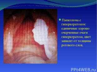 Папиллома с гиперкератозом: единичные хорошо очерченные очаги гиперкератоза, цве