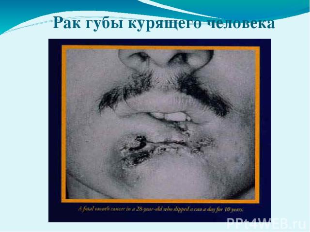 Рак губы курящего человека