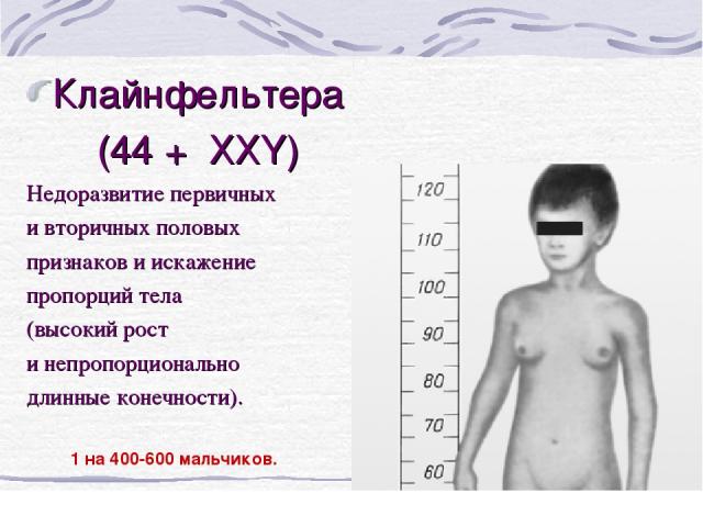 Клайнфельтера (44 + ХХY) Недоразвитие первичных и вторичных половых признаков и искажение пропорций тела (высокий рост и непропорционально длинные конечности). 1 на 400-600 мальчиков.