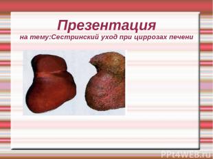 Презентация на тему:Сестринский уход при циррозах печени