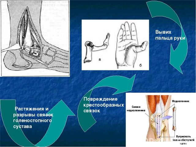 Растяжения и разрывы связок голеностопного сустава Вывих пальца руки Повреждение крестообразных связок