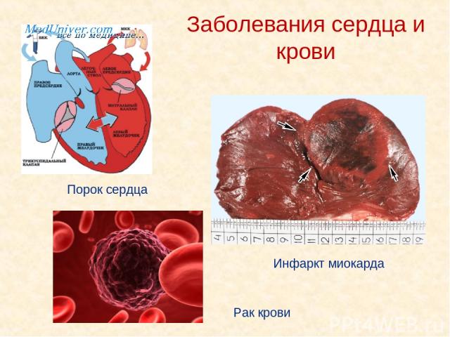 Заболевания сердца и крови Инфаркт миокарда Порок сердца Рак крови