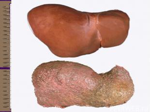 Печень Ожирение печеночных клеток (жировая дистрофия) у людей, пристрастившихся