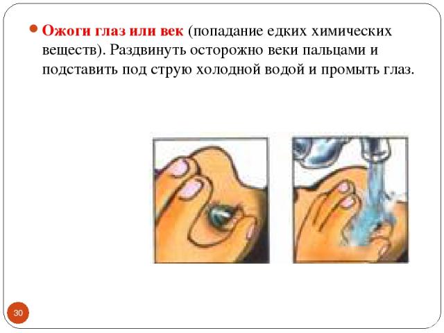 * Ожоги глаз или век (попадание едких химических веществ). Раздвинуть осторожно веки пальцами и подставить под струю холодной водой и промыть глаз.