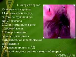 1. Острый период Клиническая картина: Сильные боли во рту, глотке, за грудиной п