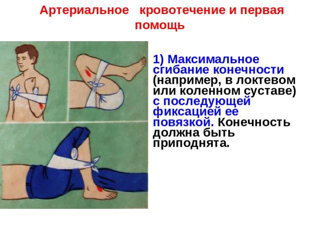 Артериальное кровотечение и первая помощь 1) Максимальное сгибание конечности (например, в локтевом или коленном суставе) с последующей фиксацией ее повязкой. Конечность должна быть приподнята.