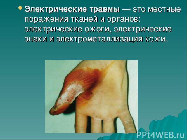 Электрические травмы — это местные поражения тканей и органов: электрические ожоги, электрические знаки и электрометаллизация кожи.