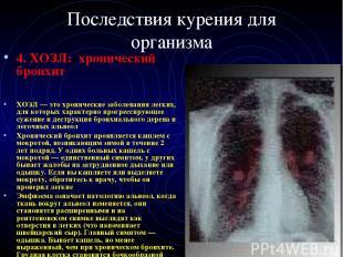 Последствия курения для организма 4. ХОЗЛ: хронический бронхит ХОЗЛ — это хронич