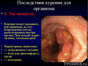 Последствия курения для организма 8. Рак пищевода Курение может вызывать рак пищ