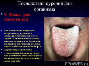 Последствия курения для организма 9. Язык: рак полости рта Рак полости рта чаще