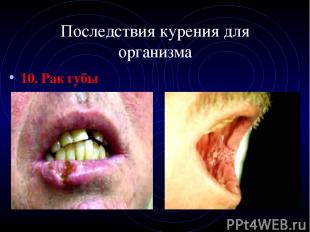 Последствия курения для организма 10. Рак губы