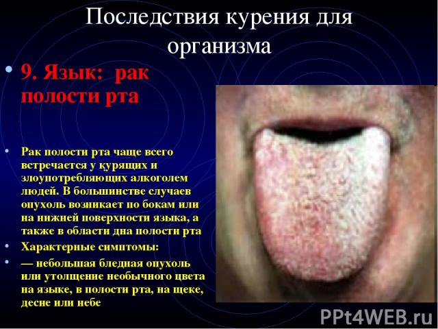 Последствия курения для организма 9. Язык: рак полости рта Рак полости рта чаще всего встречается у курящих и злоупотребляющих алкоголем людей. В большинстве случаев опухоль возникает по бокам или на нижней поверхности языка, а также в области дна п…