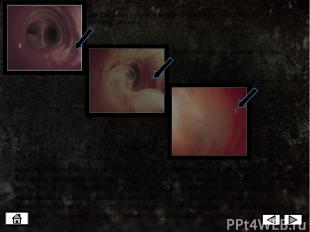 Эти 4 снимка показывают быстрое распространение опухоли в легких одного и того ж