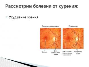 Ухудшение зрения Рассмотрим болезни от курения: