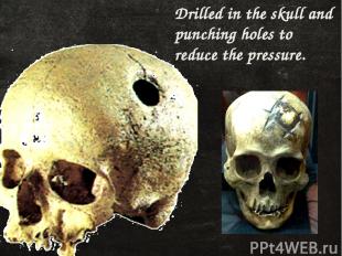 Drilled in the skull and punching holes to reduce the pressure.