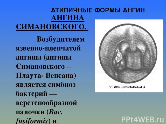 АТИПИЧНЫЕ ФОРМЫ АНГИН АНГИНА СИМАНОВСКОГО. Возбудителем язвенно-пленчатой ангины (ангины Симановского – Плаута- Венсана) является симбиоз бактерий — веретенообразной палочки (Bac. fusiformis) и спирохеты полости рта (Spirochaeta buccalis), поэтому з…