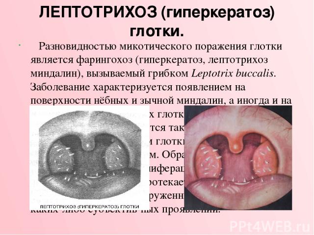 ЛЕПТОТРИХОЗ (гиперкератоз) глотки. Разновидностью микотического поражения глотки является фарингохоз (гиперкератоз, лептотрихоз миндалин), вызываемый грибком Leptotrix buccalis. Заболевание характеризуется появлением на поверхности нёбных и зычной м…