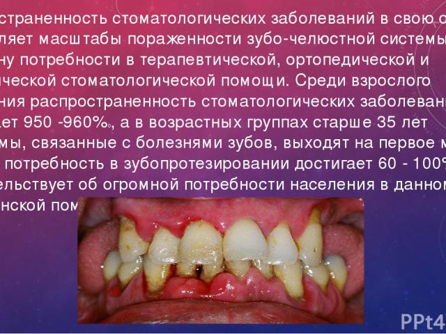 Распространенность стоматологических заболеваний в свою очередь определяет масштабы пораженности зубо-челюстной системы и величину потребности в терапевтической, ортопедической и хирургической стоматологической помощи. Среди взрослого населения расп…