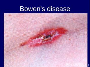 Bowen's disease