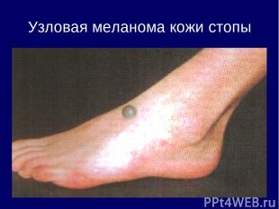 Узловая меланома кожи стопы