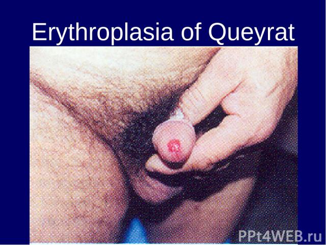 Erythroplasia of Queyrat