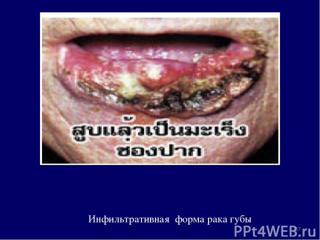 Инфильтративная форма рака губы *