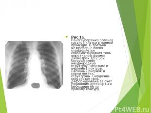 Рис.1а. Рентгенограмма органов грудной клетки в прямой проекции. В третьем межре