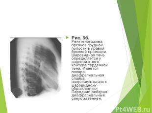 Рис. 5б. Рентгенограмма органов грудной полости в правой боковой проекции. Шаров