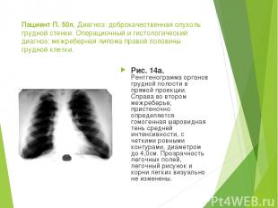 Пациент П. 50л. Диагноз: доброкачественная опухоль грудной стенки. Операционный
