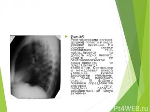 Рис.3б. Рентгенограмма органов грудной полости в левой боковой проекции. На боко