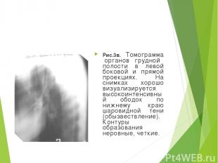Рис.3в. Томограмма органов грудной полости в левой боковой и прямой проекциях. Н