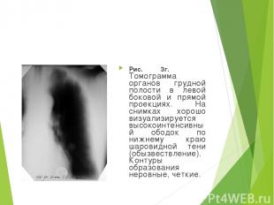 Рис. 3г. Томограмма органов грудной полости в левой боковой и прямой проекциях.